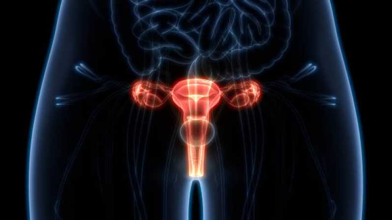 Exame de Histerossalpingografia Agendar Vila Vermelha - Exame de Histerossalpingografia para Endometriose