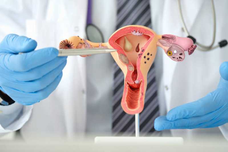 Exame de Histerossalpingografia Bilateral Agendar Vila Liviero - Exame de Histerossalpingografia para Endometriose