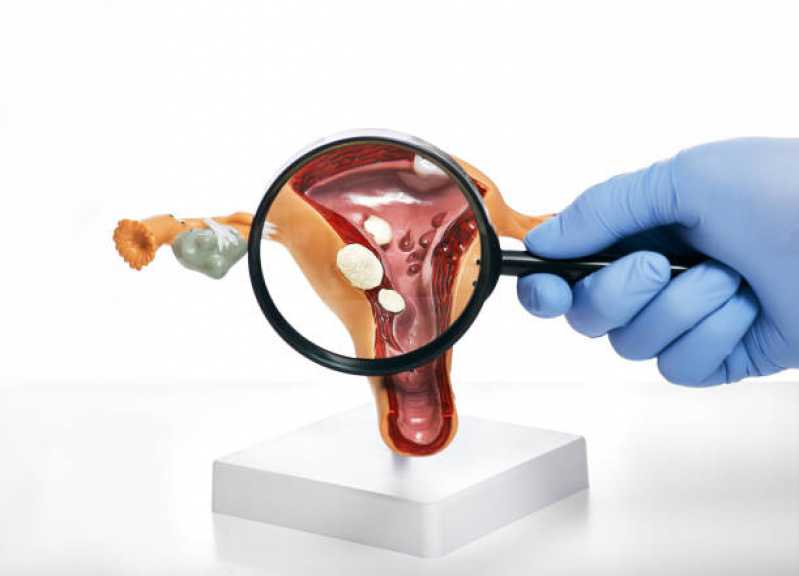 Exame de Histerossalpingografia Bilateral Capão do Embira - Exame de Histerossalpingografia no útero