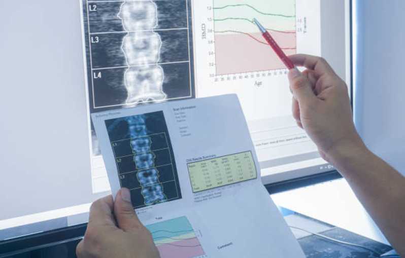 Onde Fazer Exame de Densitometria óssea Osteoporose Saúde - Exame de Densitometria óssea Coluna