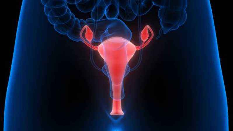 Onde Fazer Exame de Histerossalpingografia Ginecológico Alto de Pinheiros - Exame de Histerossalpingografia no útero