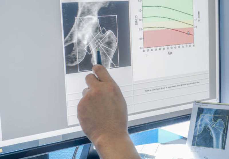 Preço de Exame de Densitometria óssea Osteoporose Vila Sofia - Exame de Densitometria óssea da Coluna