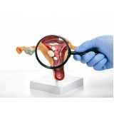exame de histerossalpingografia no útero Vila Vermelha