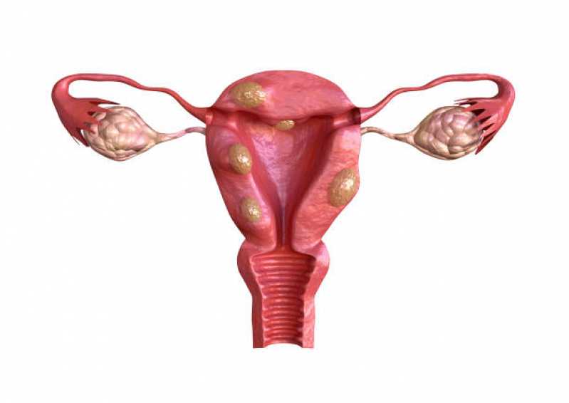 Valor de Exame de Histerossalpingografia com Anestesia Jardim Belga - Exame de Histerossalpingografia para Endometriose
