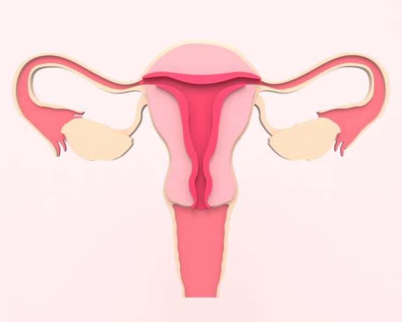 Valor de Exame de Histerossalpingografia com Sedação Santo Amaro - Exame de Histerossalpingografia para Endometriose